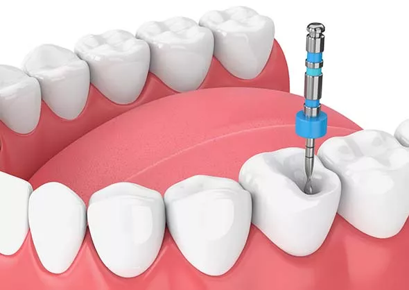 3D animated image of root canal procedure from inside the mouth